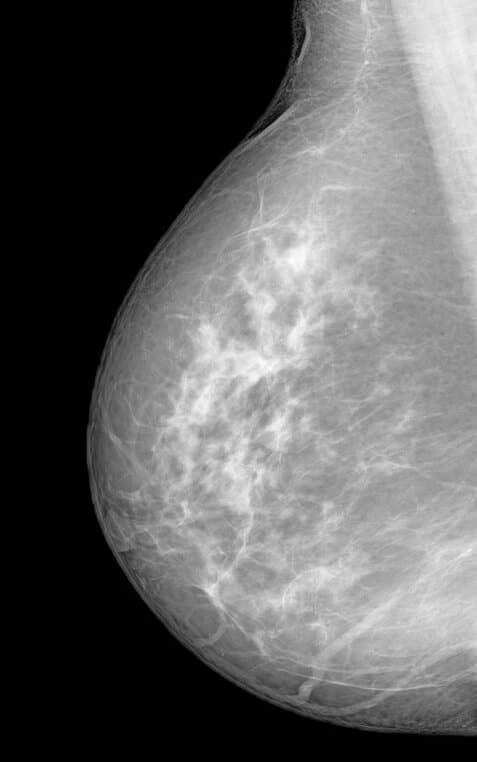 Mammographie et dépistage du cancer du sein à Nice