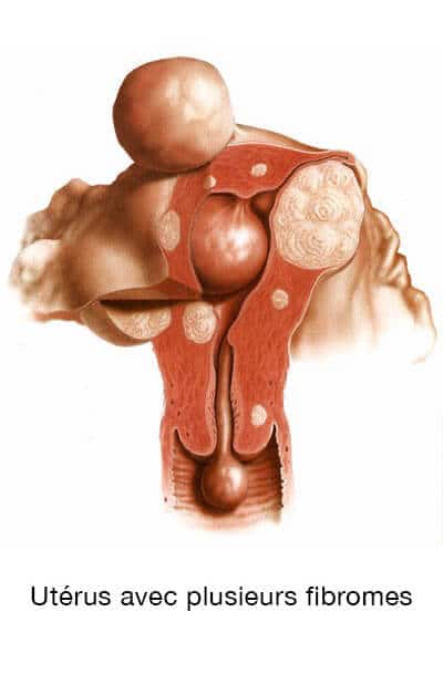 Utérus avec fibromes
