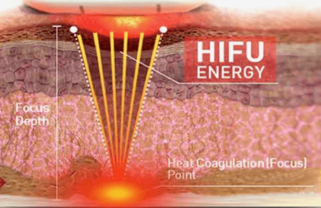 Traitement par Ultrasons Focalisés de Haute Intensité (HIFU) à Nice